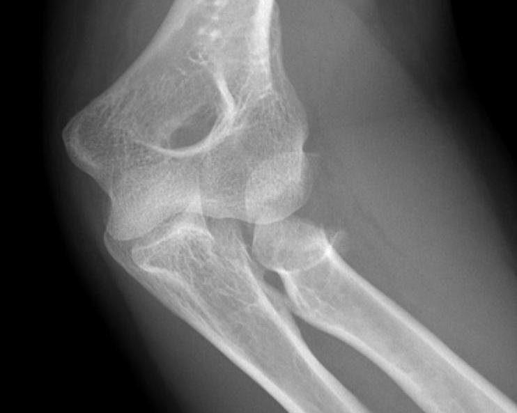 Radial Head Fracture Mason 2